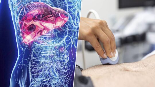 El hígado graso, una amenaza silenciosa que preocupa a la ciencia