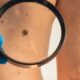 Cuba desarrolla tratamiento para el cáncer de piel, en medio de crisis