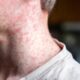 Alertan sobre posibilidad de epidemia mayor de sarampión en EE. UU.