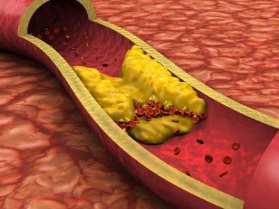 La aterosclerosis puede provocar infartos y accidente cerebrovascular
